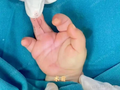 4 к 5! Эта операция не просто разделила сросшиеся пальцы ребенка, она также о...